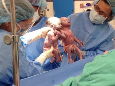 Día de la madre: gemelas nacen agarradas de la mano -VIDEO