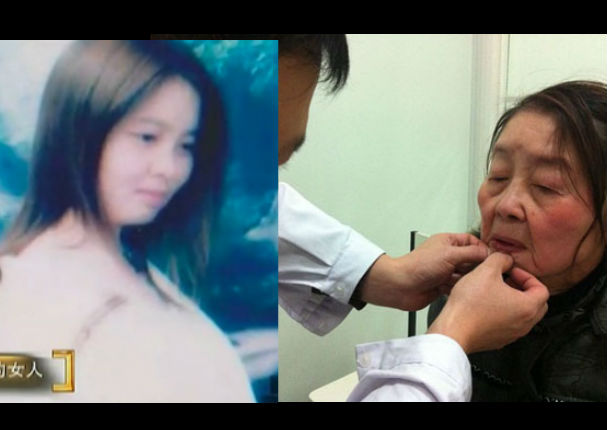 China: Mujer de 29 años luce como de 80 debido a extraña enfermedad