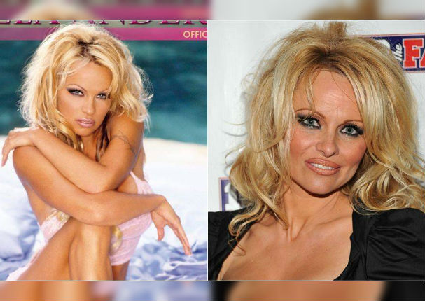 ¡Terrible! 11 famosos que abusaron del botox y las cirugías (FOTOS)