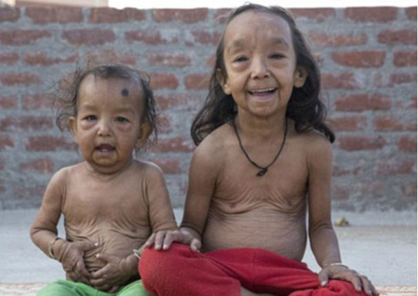 ¡Increíble! Dos niños sufren la misma 'enfermedad' que 'Benjamin Button' (FOTOS)