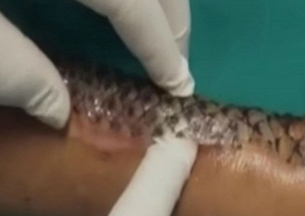 YouTube: Se quemó los brazos y se cubrió con escamas de pescado