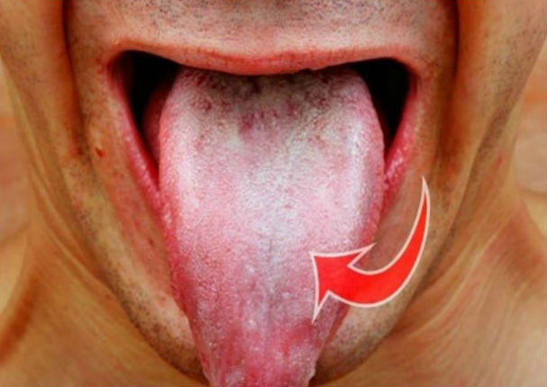 YouTube: ¿Qué pasa si tienes manchas blancas en la lengua ? ¡Alerta!