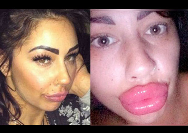 Viral: Se aumentó los labios y quedó descontenta por este motivo - FOTOS