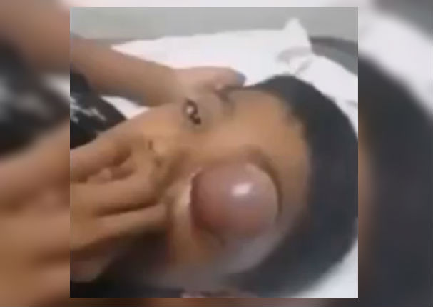 Youtube Viral: Grano gigante en la cara de un niño se vuelve viral (VIDEO)