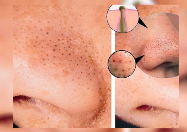 Belleza: Eliminar los puntos negros de la nariz puede ser muy sencillo