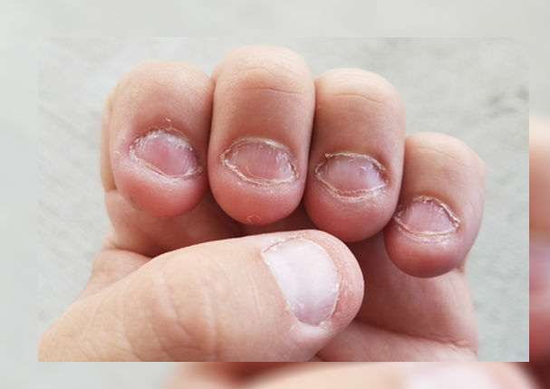 Mujer desarrolló cáncer por morderse las uñas