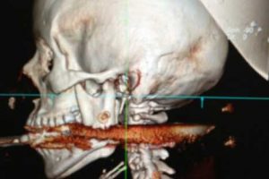 Brasil: Mujer fue atravesada por arpón y vive para contarlo