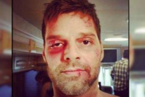 Ricky Martin sorprender a sus fans al aparecer con rostro golpeado en Instagram