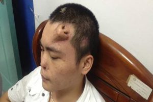 Médicos chinos “cultivan” naríz en la frente de un paciente