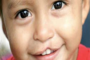 Promueven campaña para la operación de menores de edad con labio leporino