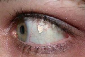 Increíble: Implantes de joyas en el ojo se vuelve una moda
