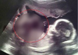 ¿Un milagro? Mujer compartió ultrasonido de su bebé ‘bendecido por un ángel’
