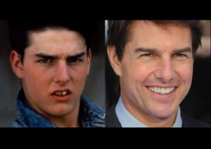 ¿Lucían mal? Mira cómo eran estas celebridades antes de tener dientes perfectos (FOTOS)