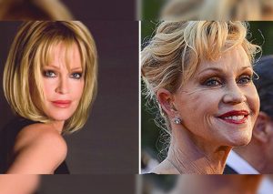 ¡Terrible! 11 famosos que abusaron del botox y las cirugías (FOTOS)