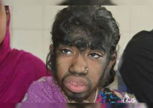 ¡Lamentable! Este es el caso de Bithi Akhtar, la ‘niña lobo’ de Bangladesh