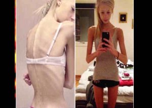 ¡Salvó su vida! Superó la anorexia y ahora luce envidiable silueta