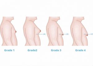 ¿Sabes por qué hay hombres con pechos grandes? Esta es la razón