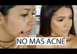 ¡Cómo una profesional! Así podrás cubrir el acné con maquillaje – VIDEO