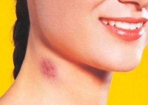 3 tips para eliminar los ‘chupetones’ del cuello